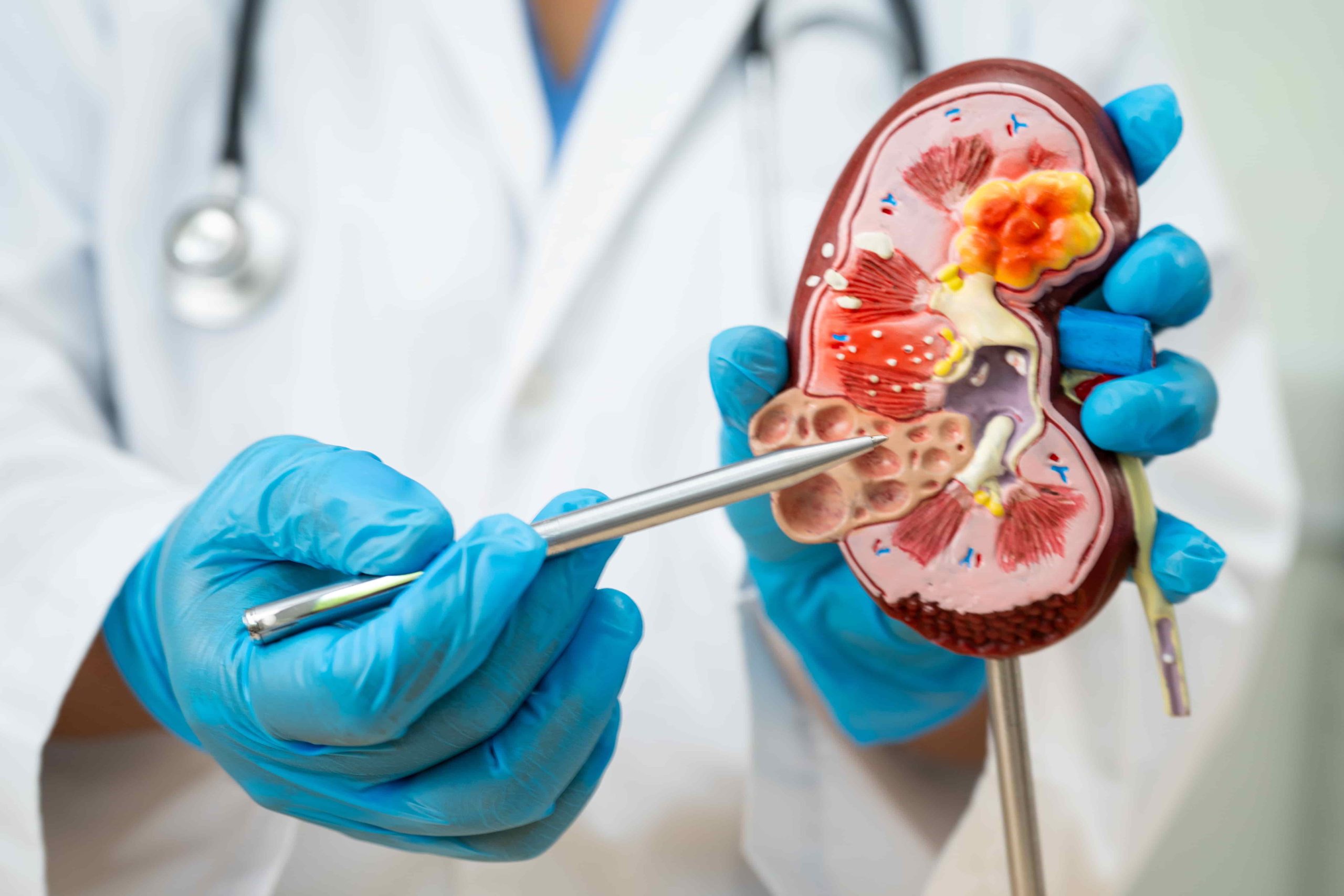 kidney cancer treatment kolhapur