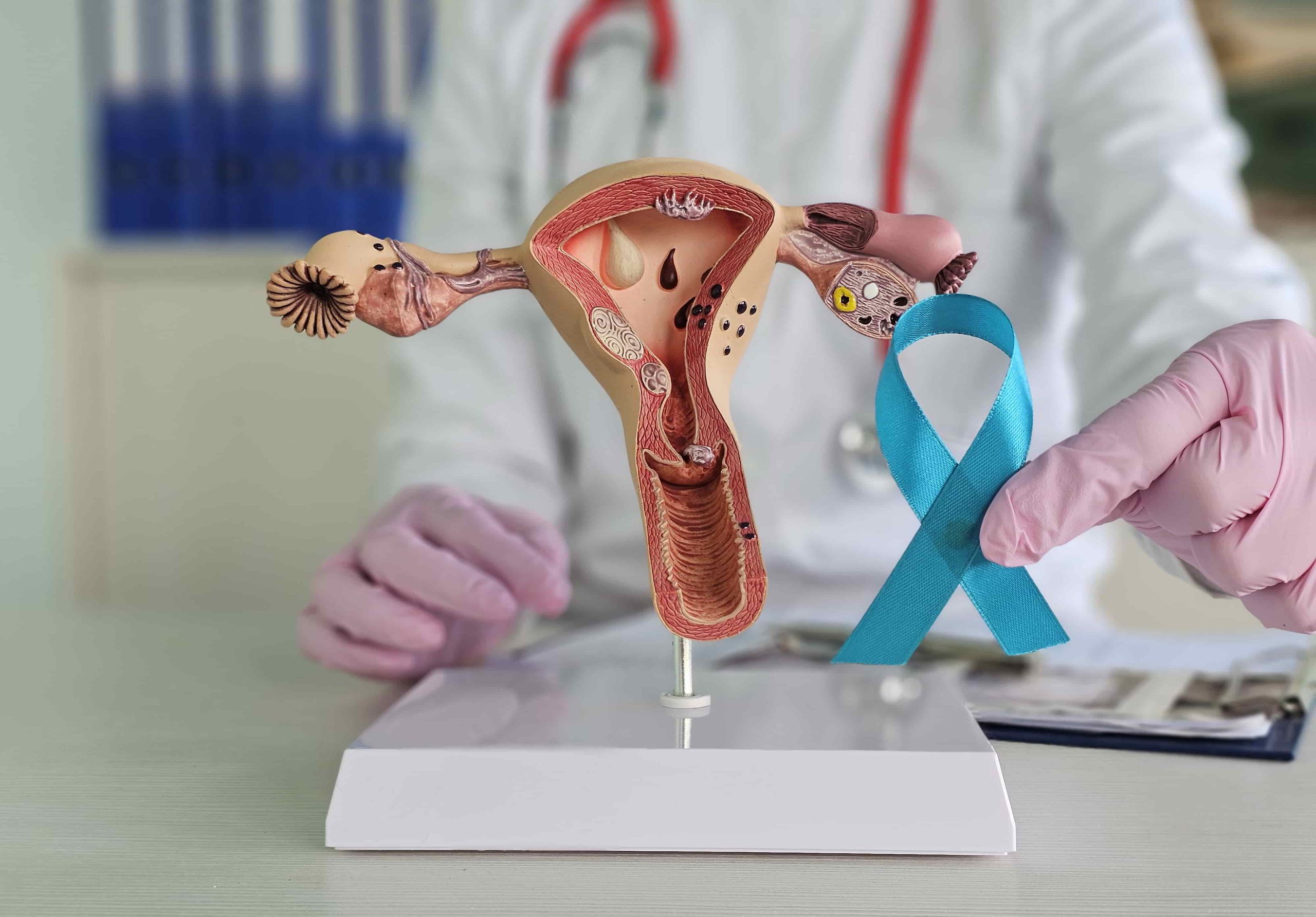 Professional ovarian cancer treatment