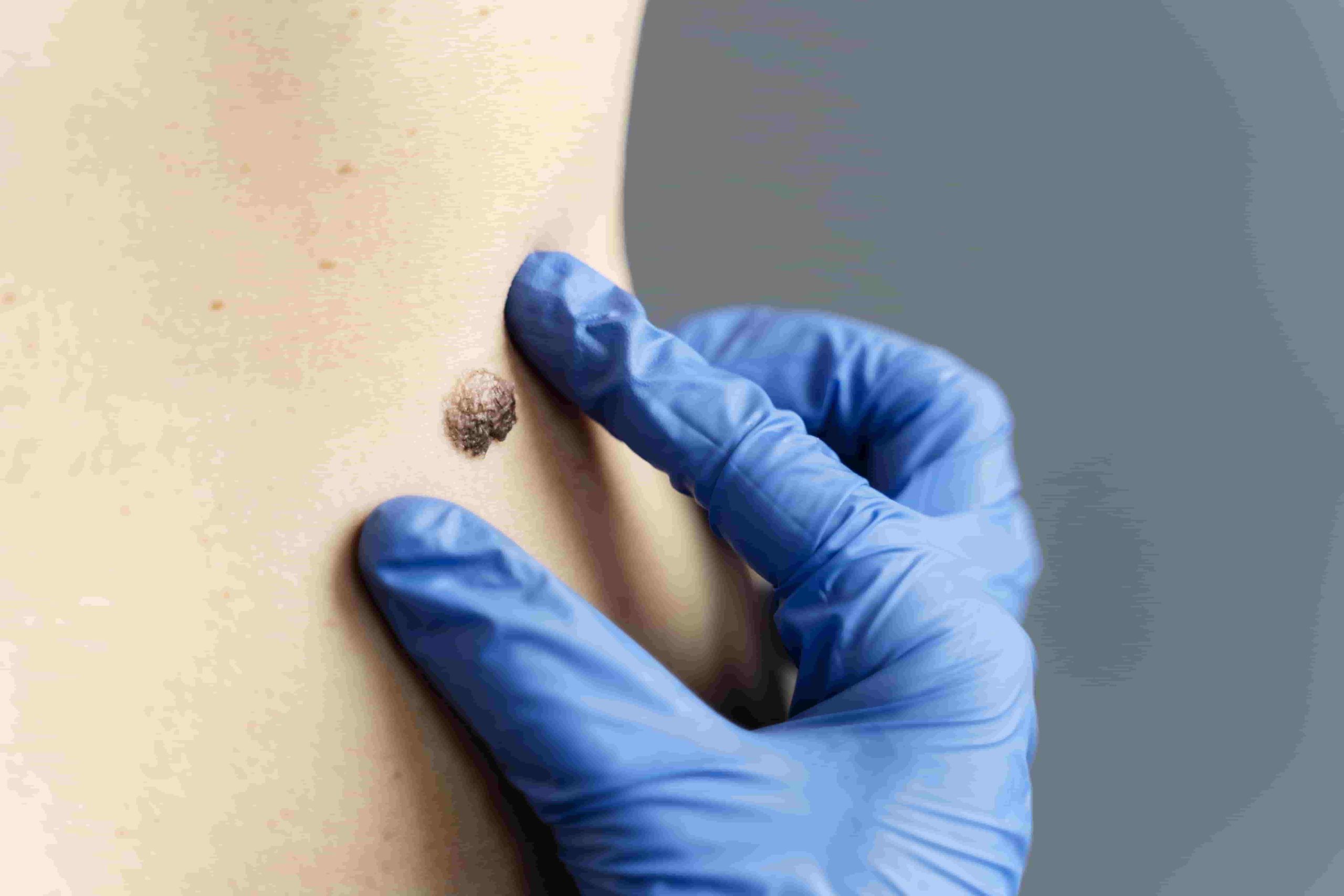 melanoma diagnosis