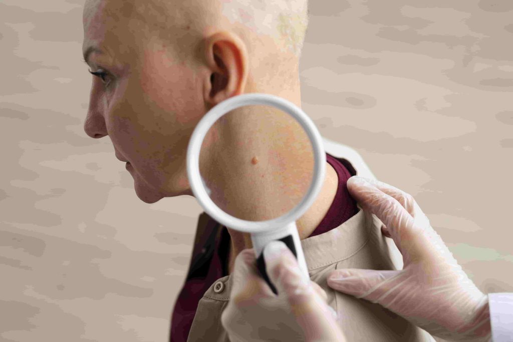 melanoma skin cancer